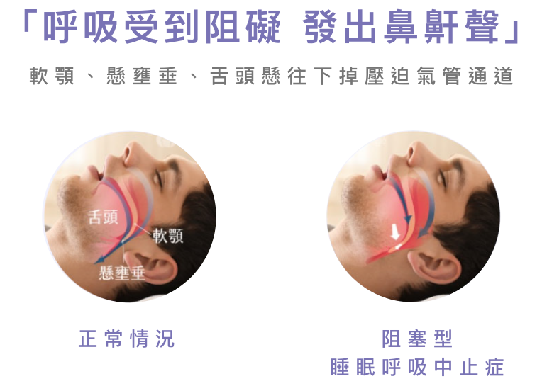 「呼吸受到阻礙 發出鼻鼾聲」
